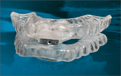 TAP APNOE anti snoring devices