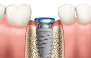 Azonnali implantáció az extrakciót követően - Dr. Riedling Zsolt fogszakorvos - Medicina Klinika Hévíz Ady Endre utca 5