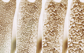 Csontrikulás - osteoporosis - kezelése és fogászati implantátum - Medicinaklinika Hévíz.