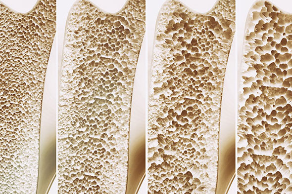 Csontrikulás - osteoporosis - kezelése és fogászati implantátum - Medicinaklinika Hévíz.